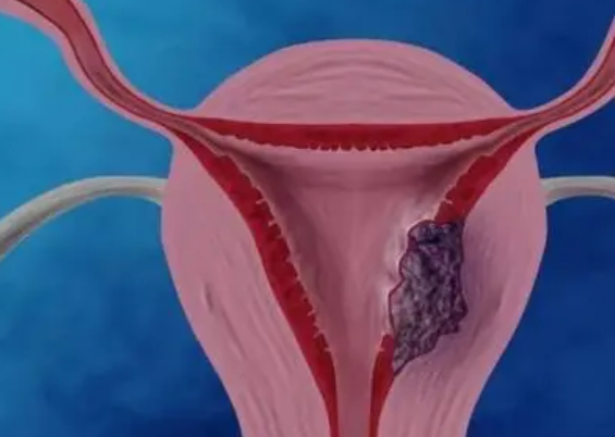 子宫内膜薄会影响移植成功率