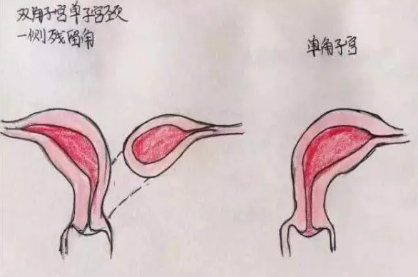 角子宫的功能可能正常