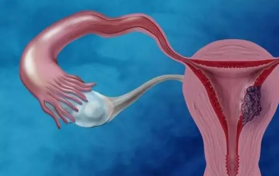 高胰岛素会导致多囊卵巢